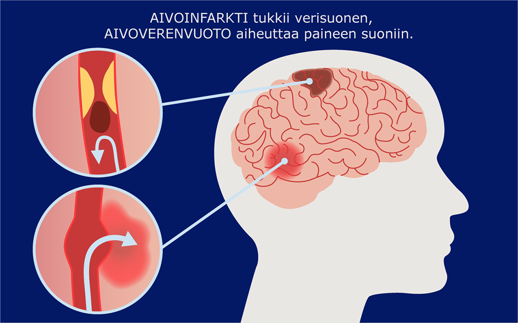 Aivoinfarkti tukkii verisuonen, aivoverenvuoto aiheuttaa paineen suoniin