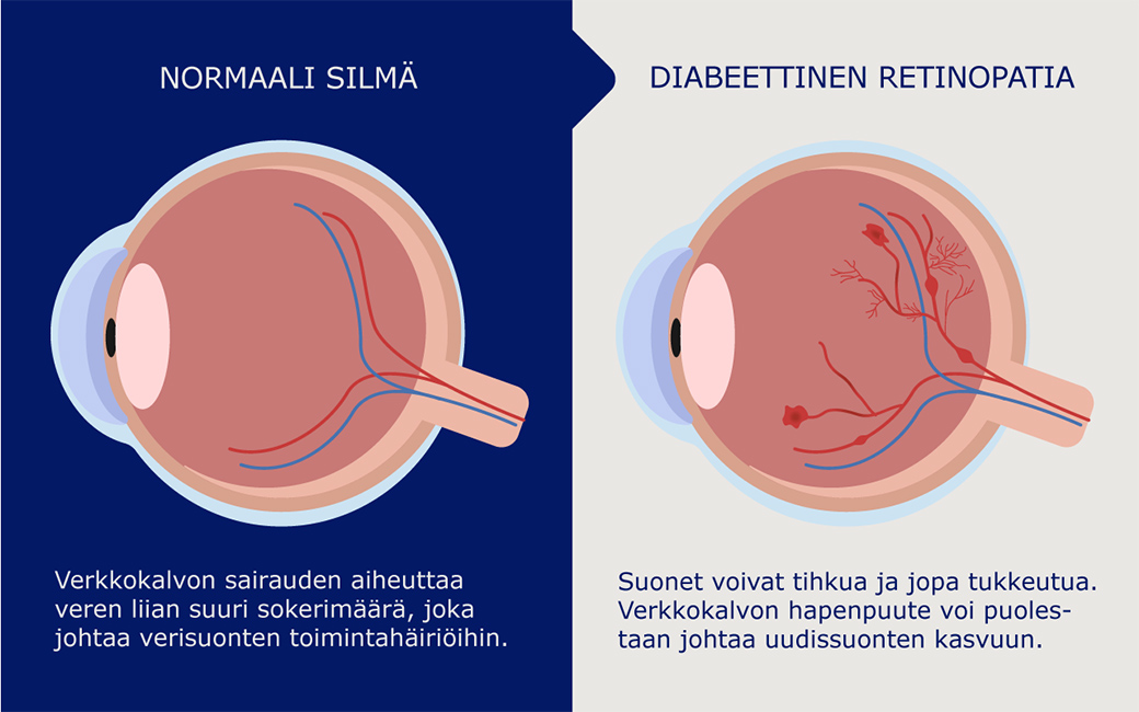 Normaali silmä ja silmä, jossa diabeettista retinopatiaa