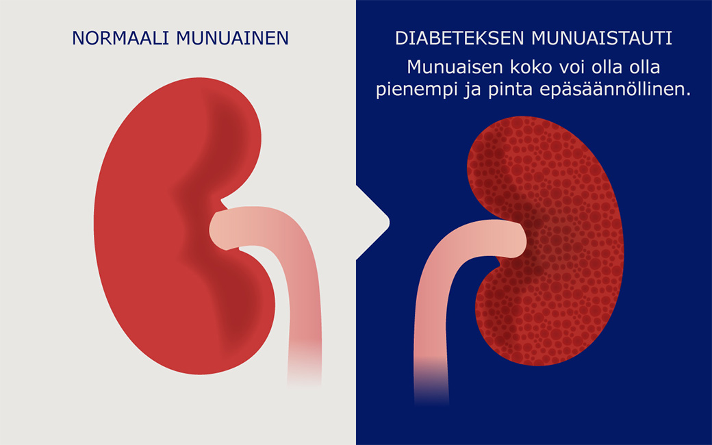 Normaali munuainen ja pienempi munuainen, jossa on diabeettisen nefropatian takia epäsäännöllinen pinta