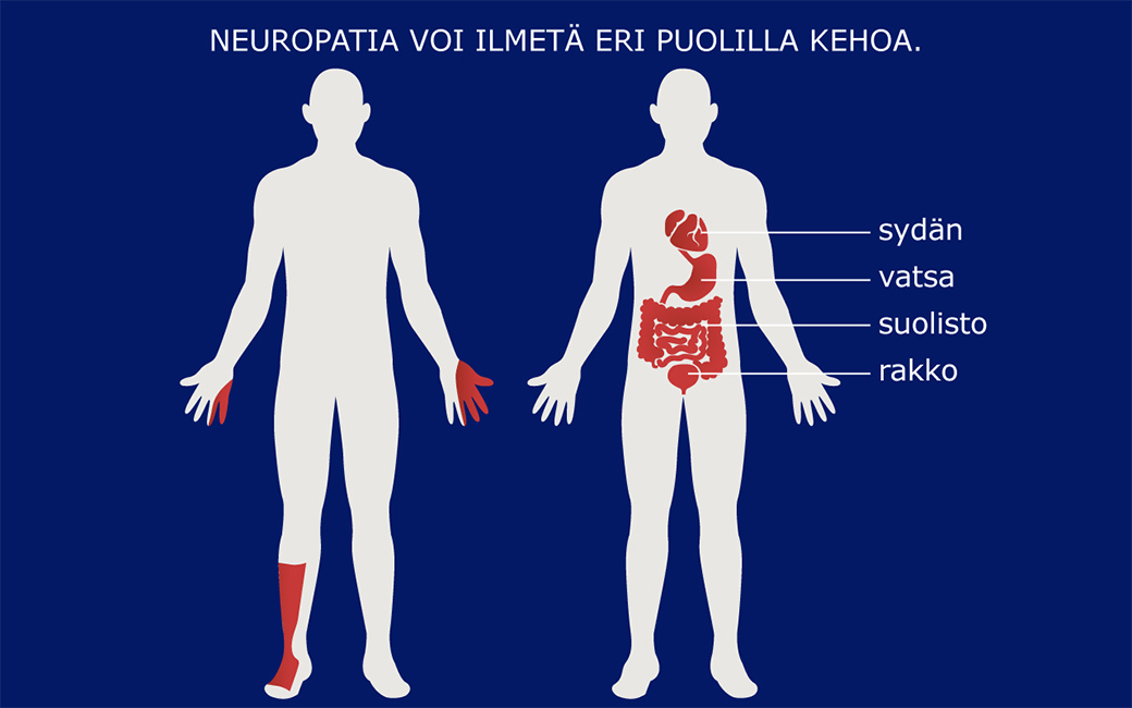 Diabeettinen neuropatia voi ilmetä alaraajoissa, ranteissa, sydämessä, vatsassa, suolistossa tai rakossa.