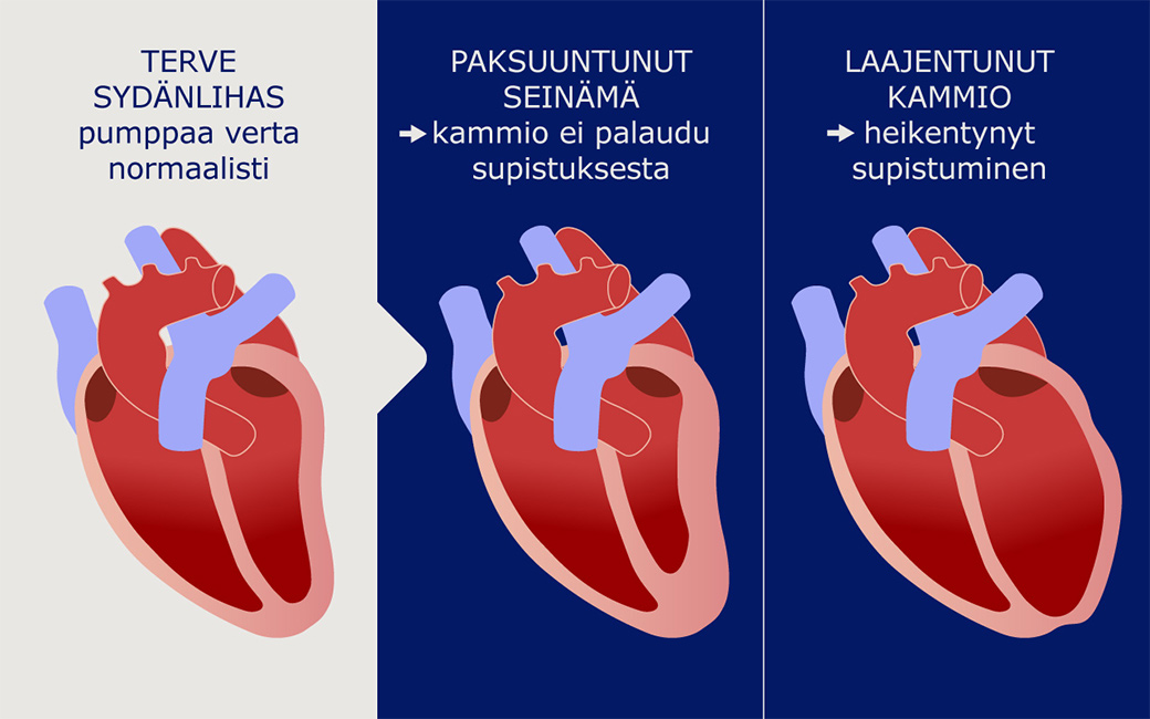 Terve sydänlihas, sydän, jossa paksuuntunut seinämä, ja sydän, jossa lajeentunut kammio