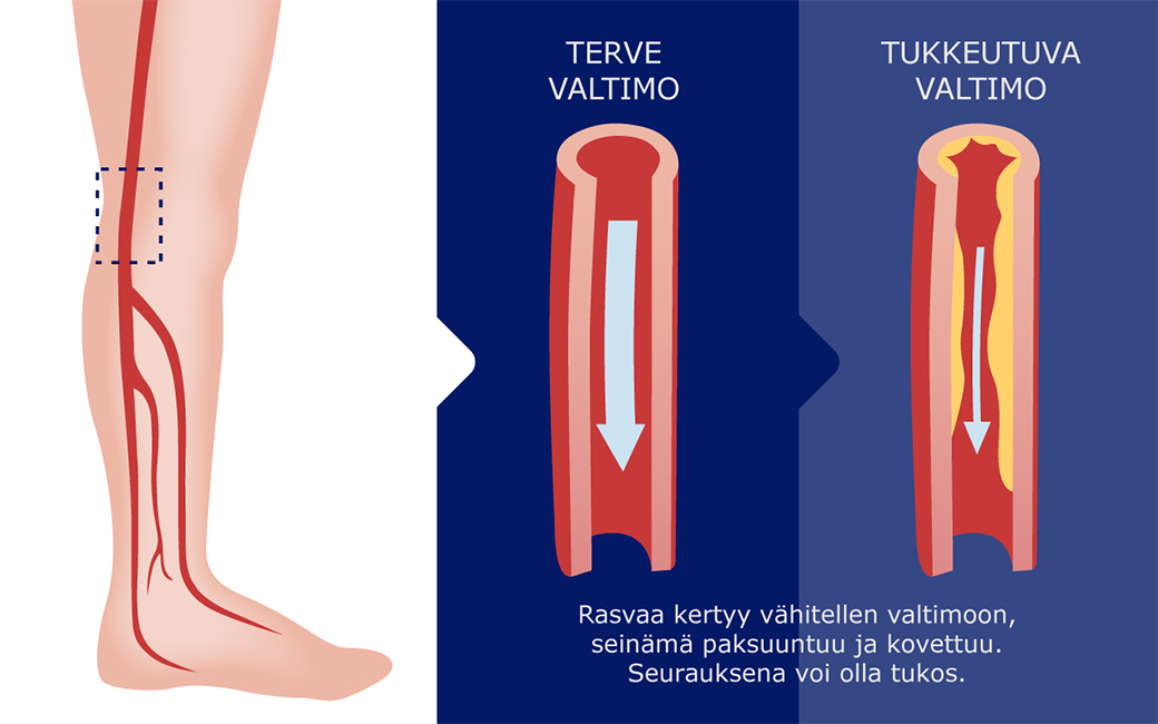erve valtimo ja tukkeutuva valtimo, jossa rasvaa on kertynyt seinämiin