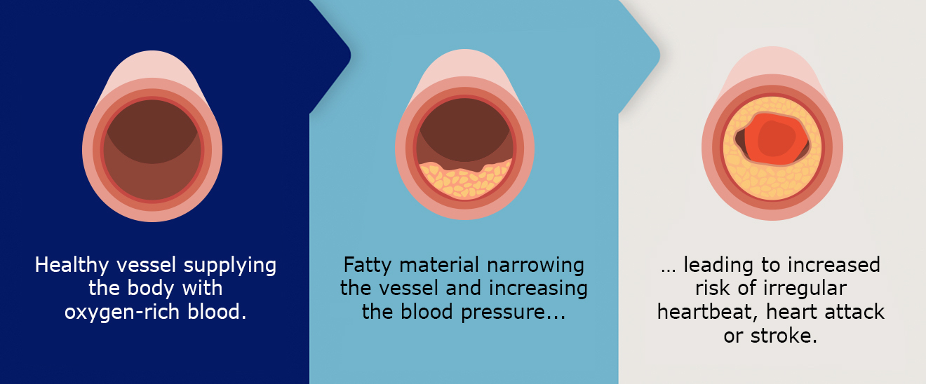 Infographic displaying the damage of sugar on blood vessels.